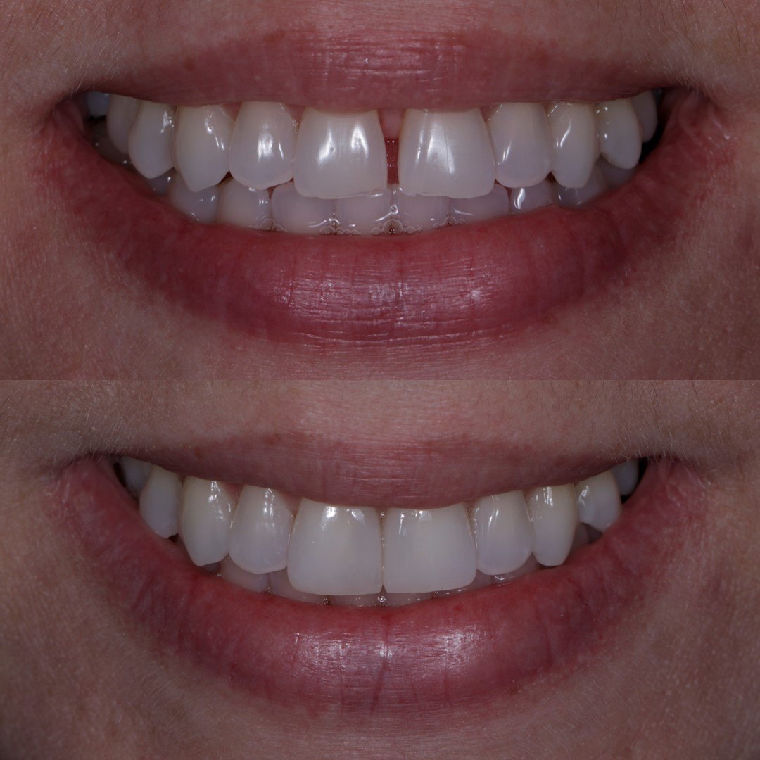 Estética dentária — fechamento de diastema