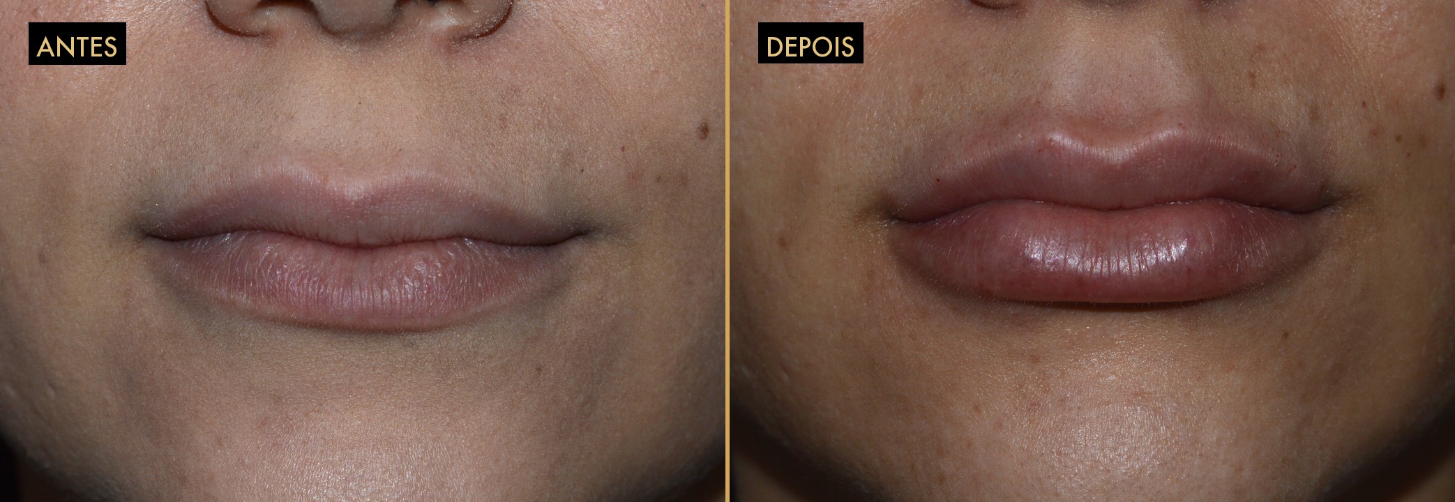 Preenchimento labial