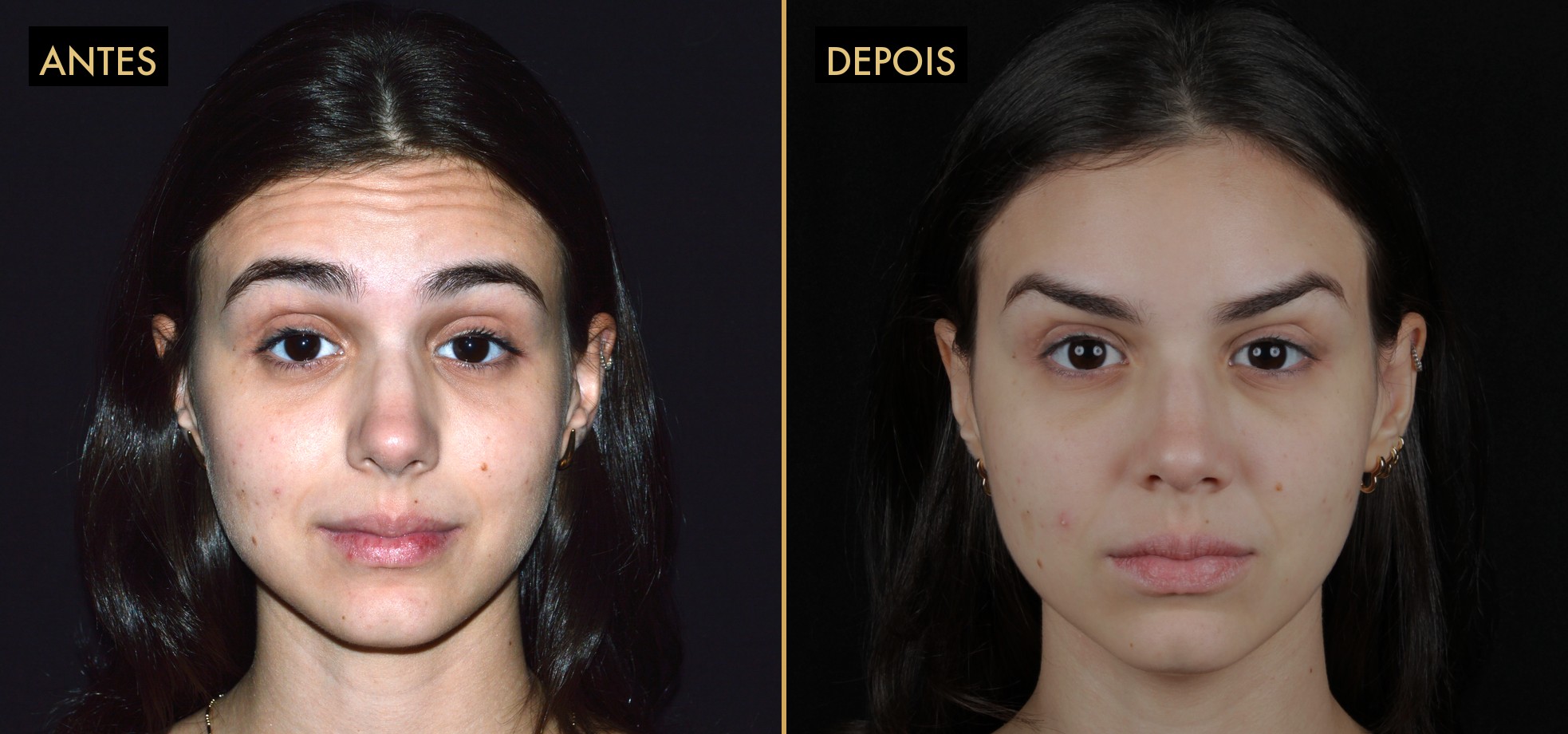 Botox + preenchimento de olheiras