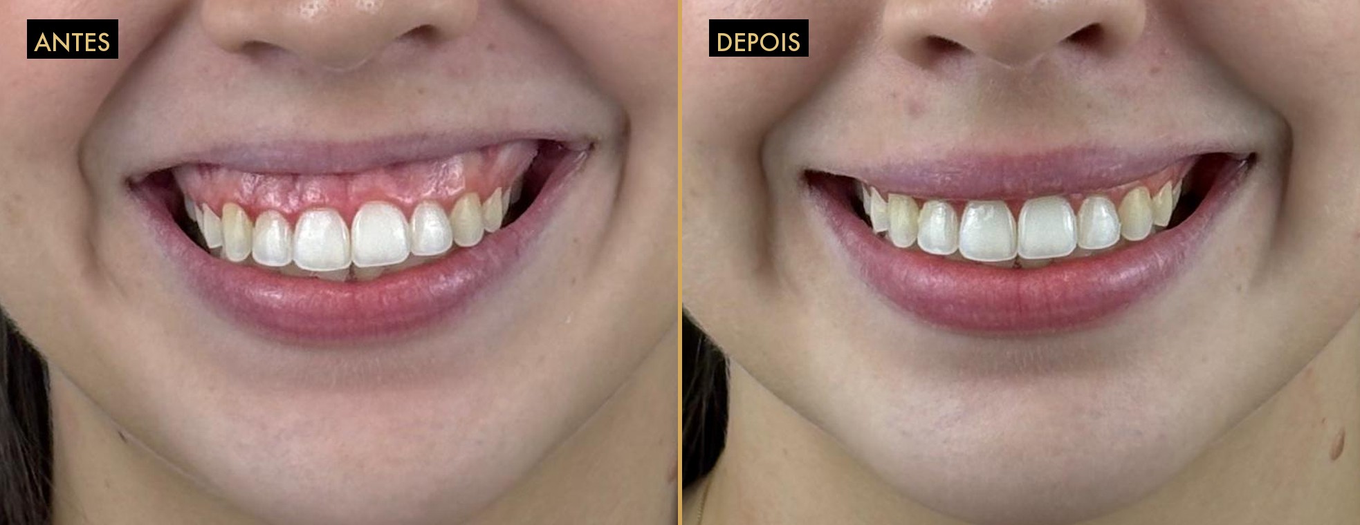 Correção de sorriso gengival com botox